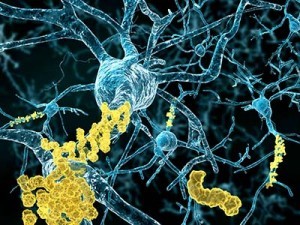 Alzheimer Krankheit - Neuronen mit Amyloid-Plaques